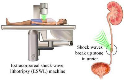 http://www.urologistindia.com/wp-content/uploads/2015/04/Extracorporeal-shock-wave-lithotripsy.jpg