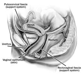 cystocele-repair